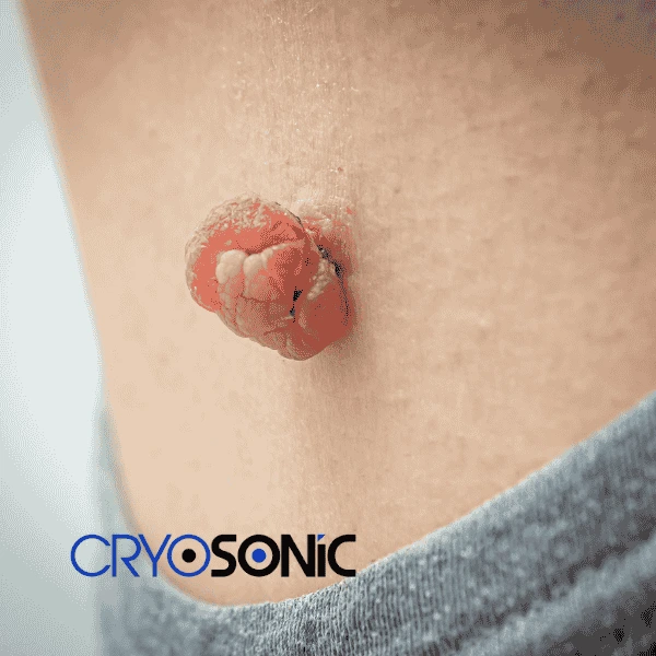 Book your skin tags removal Farnborough from comfort of your own home! Farnborough