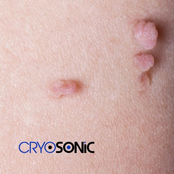 Are you looking for fast effect skin tag removal Farnborough? Book in NOW! Farnborough